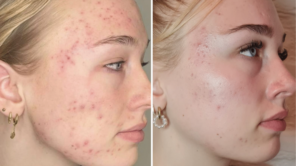 Ipl Acne - Studio Rosa Hoevelaken, Amersfoort