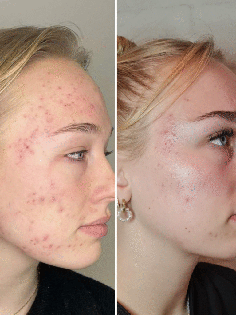 Ipl Acne - Studio Rosa Hoevelaken, Amersfoort