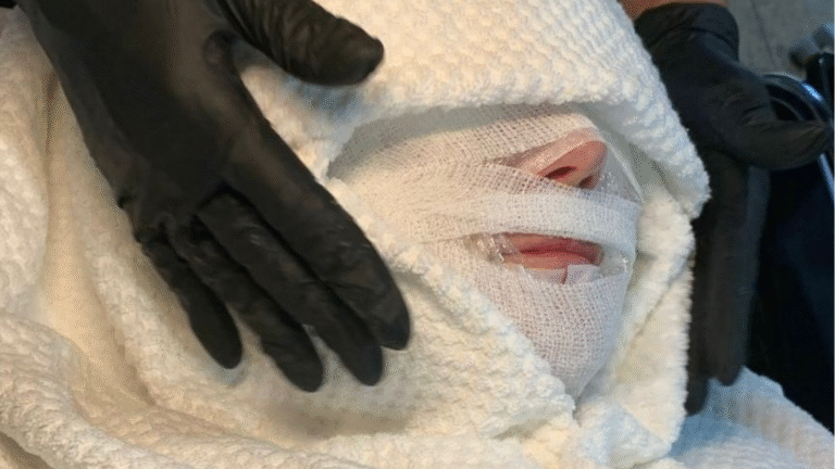 CO2 Carboxytherapie behandeling bij Studio Rosa Hoevelaken
