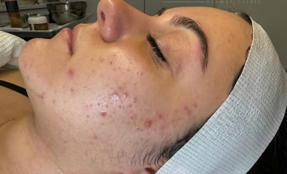 Onzuivere huid met acne voorafgaand aan een gezichtsbehandeling.