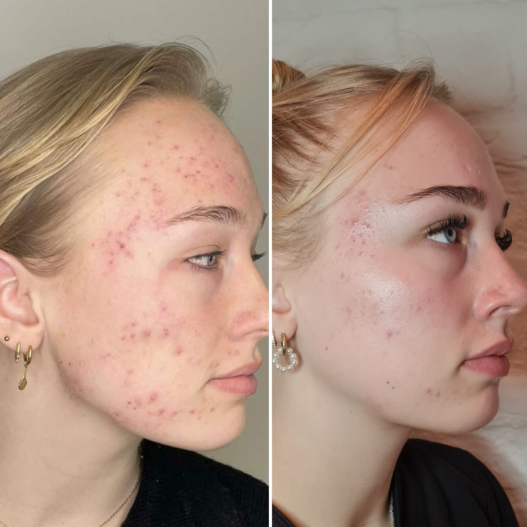 Voor-en-na resultaat van een IPL-behandeling bij acne.